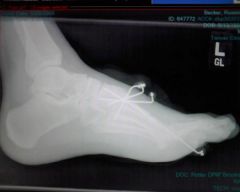 Side x-ray
(may 29, 2008)