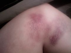 elbow bruise